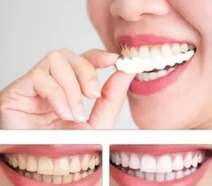 CARILLAS DENTALES + ASESORIA SONRISA PEREFCTA